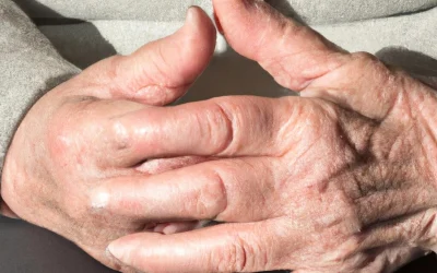 Treatment of osteoarthritis at home