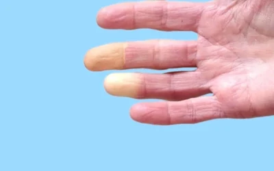 What is Raynaud’s Phenomenon and how to detect it